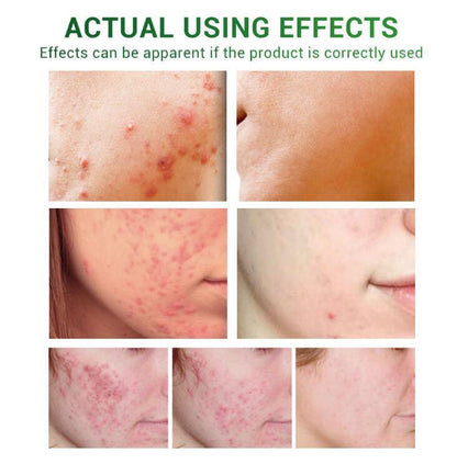 Facial Repair Oil | Acne Treatment Serum | Skin Versaa