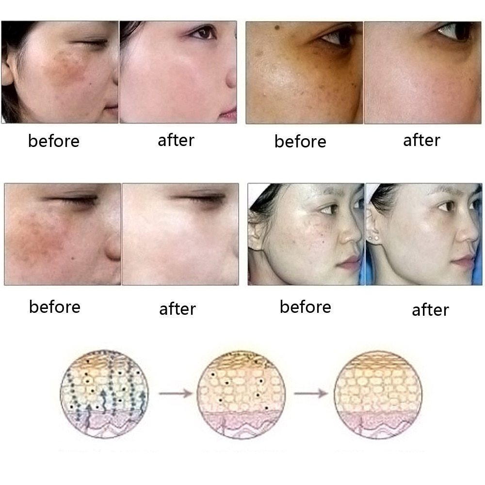 Scar Removal Oil | Marks Removal Oil | Skin Versaa
