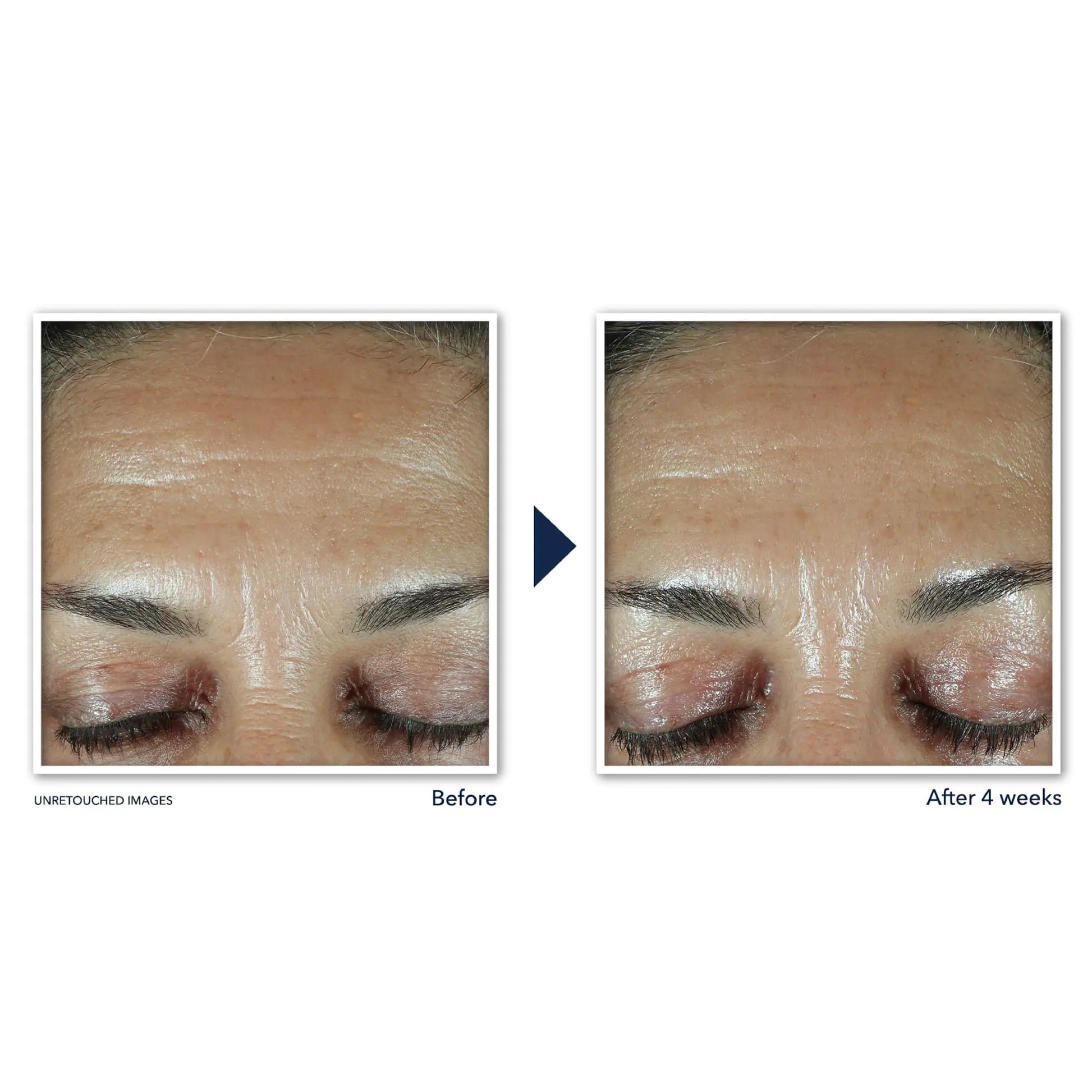 Roc Retinol Correxion | Roc Wrinkle Filler | Skin Versaa